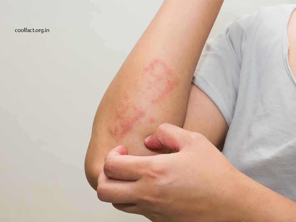 Types of Skin Allergies